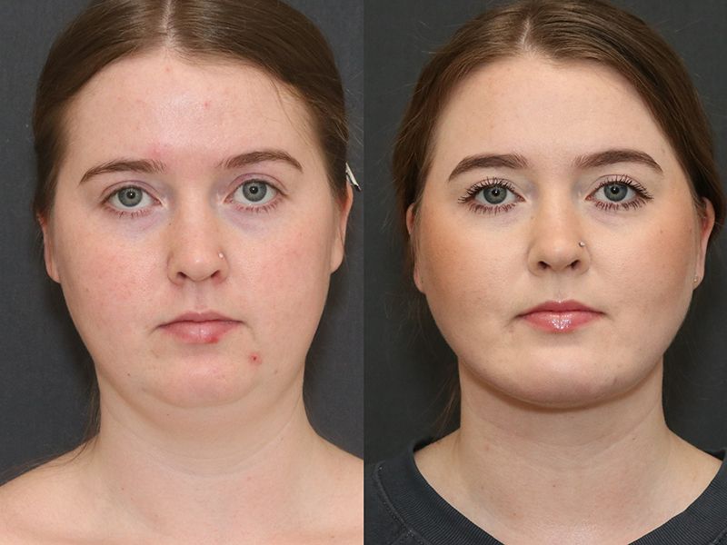 Deep Necklift Before & After
