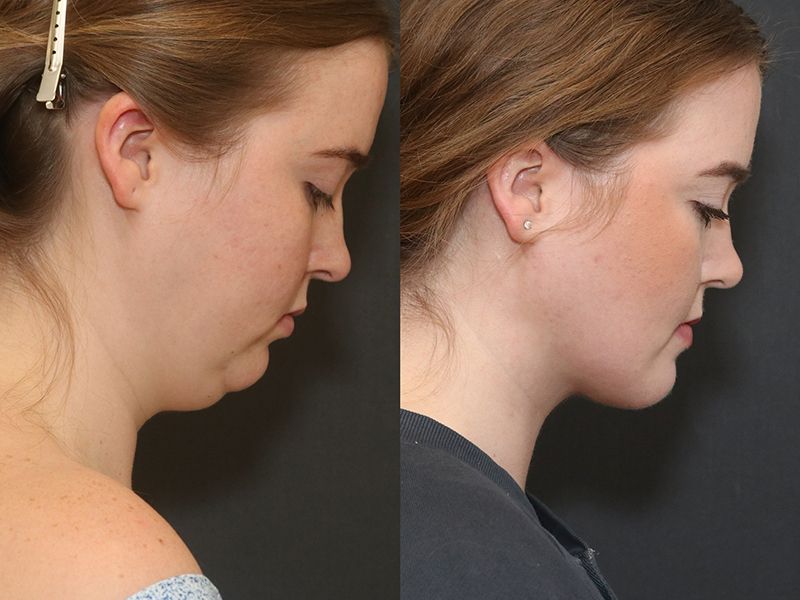Deep Necklift Before & After
