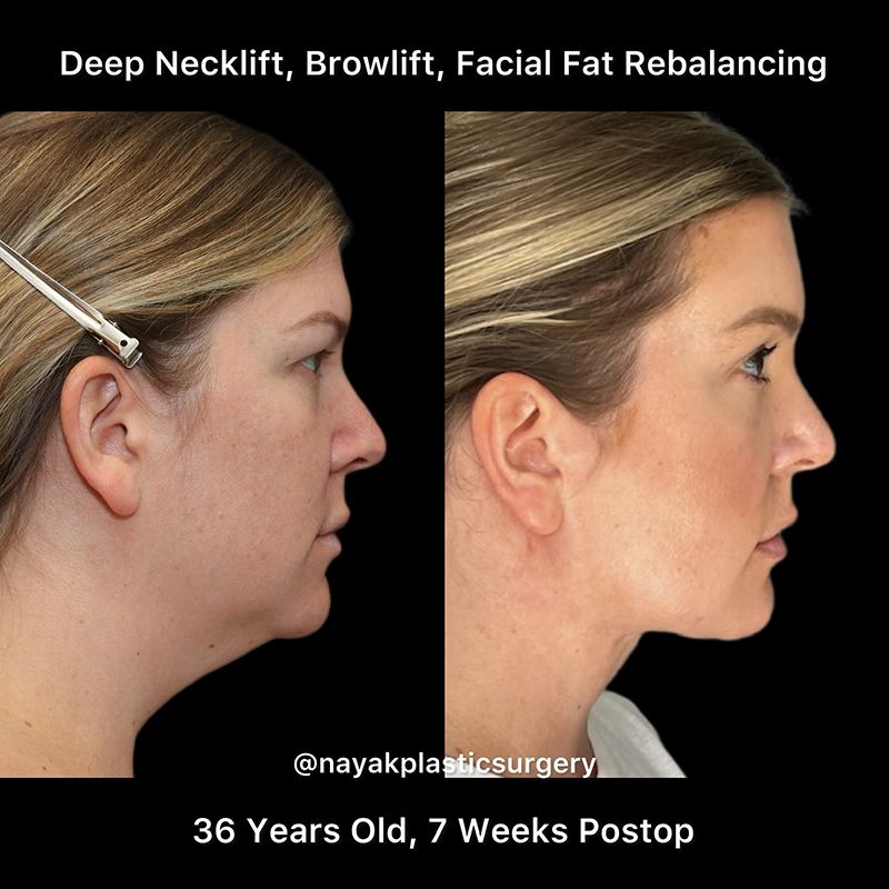Deep Necklift Before & After