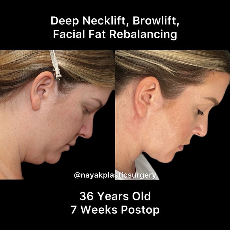 Deep Necklift Before & After