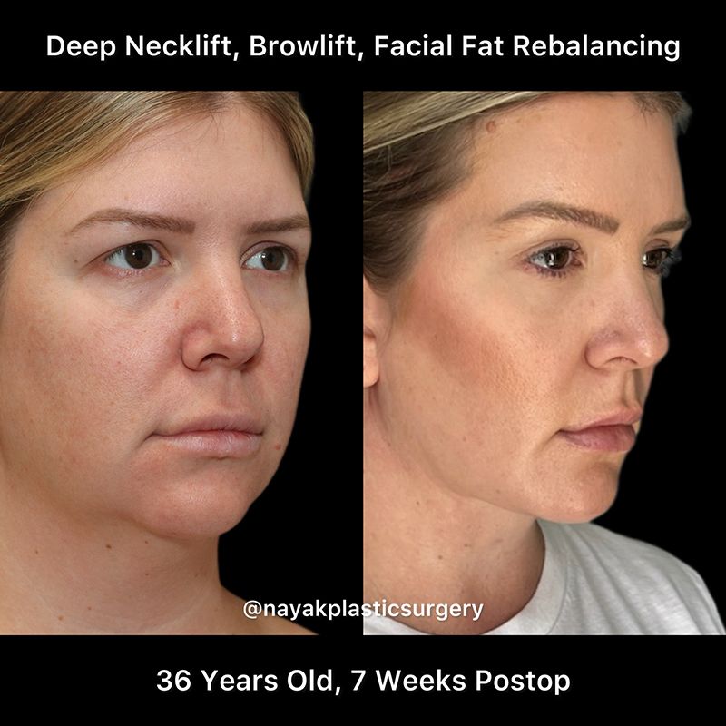 Deep Necklift Before & After