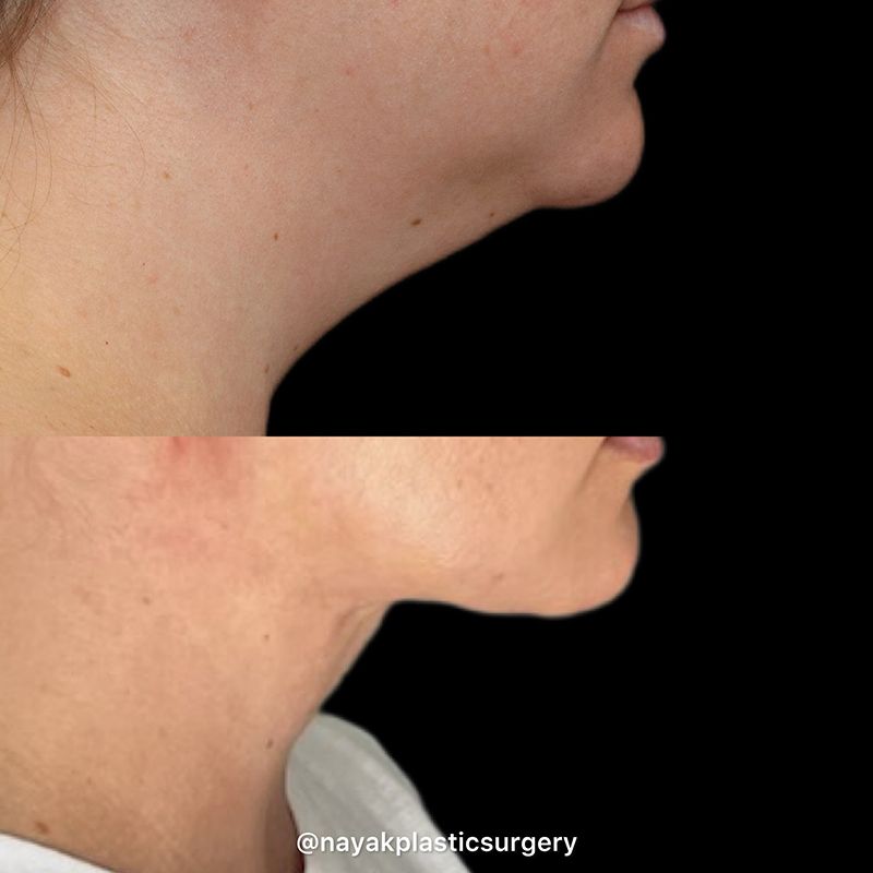 Deep Necklift Before & After