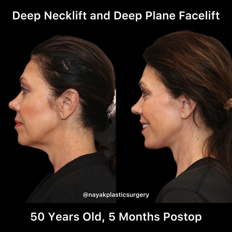 Deep Necklift Before & After