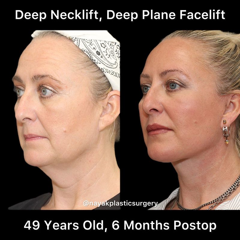 Deep Necklift Before & After