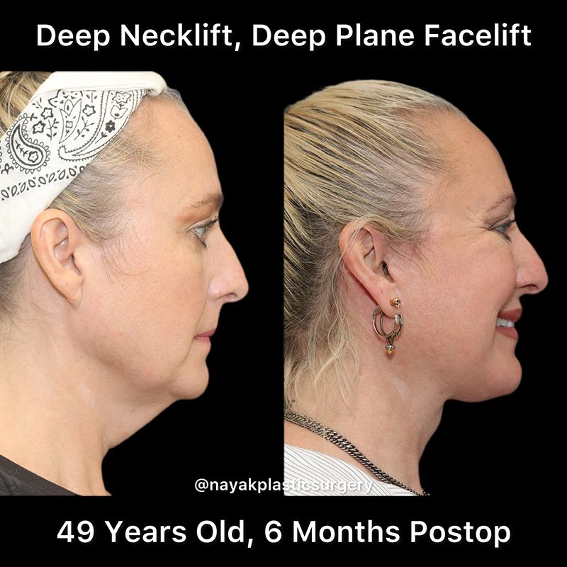 Deep Necklift Before & After