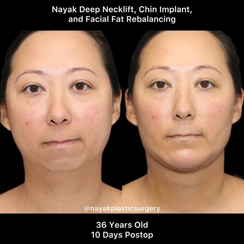 Deep Necklift Before & After