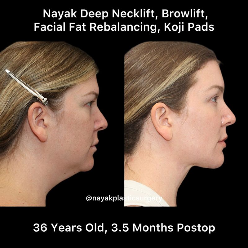 Deep Necklift Before & After