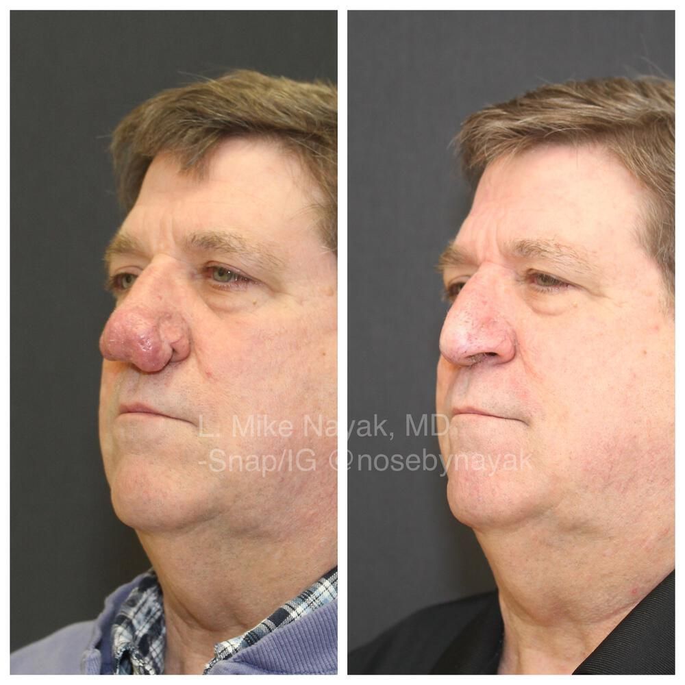 Rhinophyma Reduction Before & After