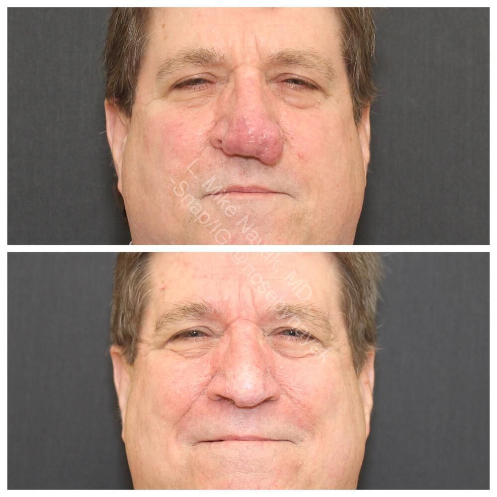 Rhinophyma Reduction Before & After