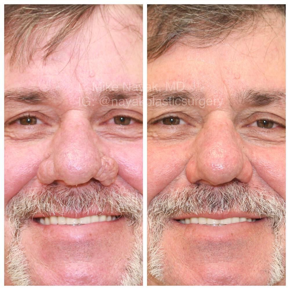Rhinophyma Reduction Before & After