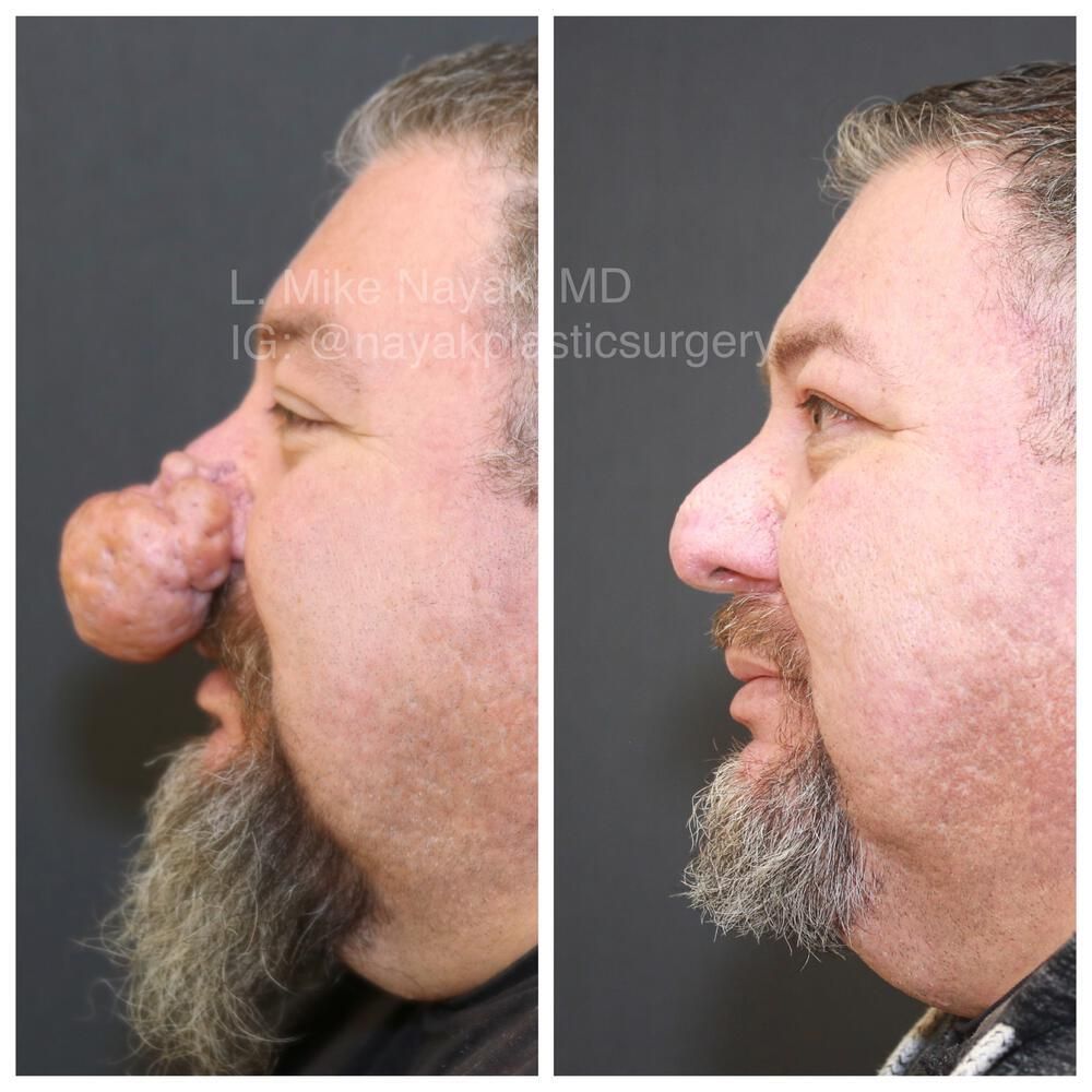 Rhinophyma Reduction Before & After