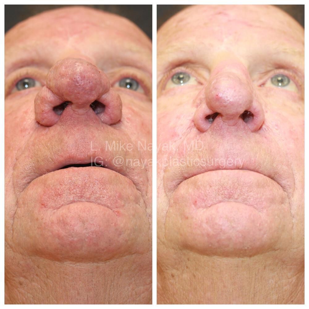 Rhinophyma Reduction Before & After