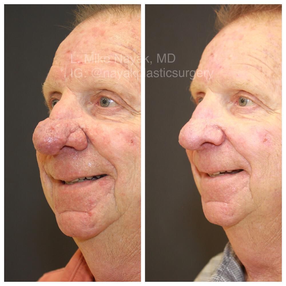 Rhinophyma Reduction Before & After