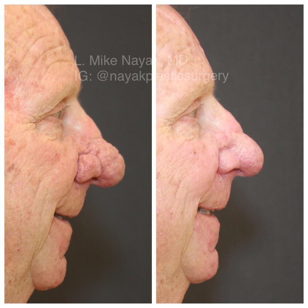 Rhinophyma Reduction Before & After