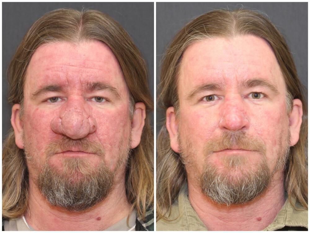 Rhinophyma Reduction Before & After