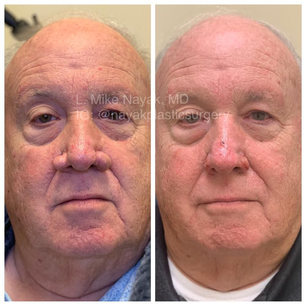 Rhinophyma Reduction Before & After