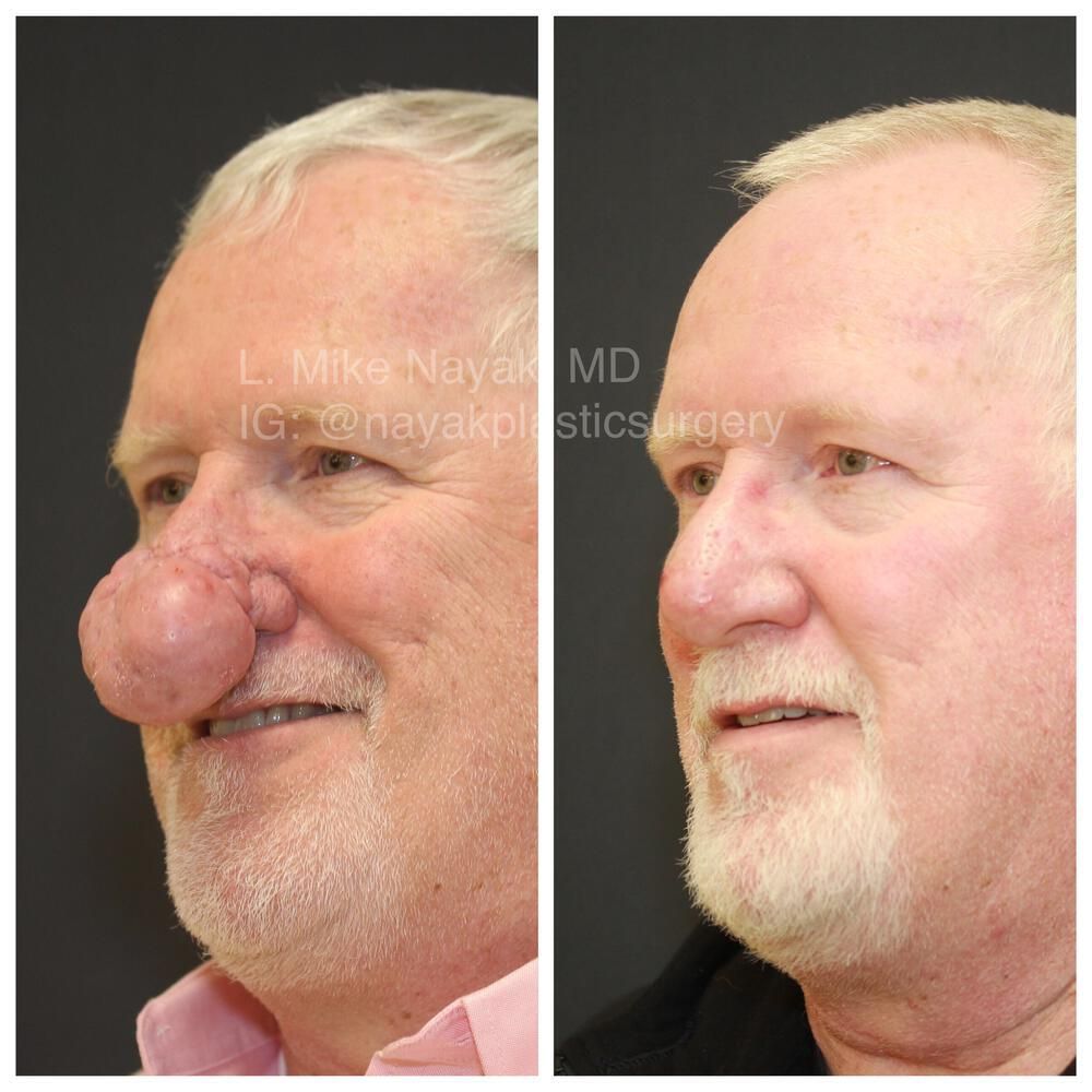 Rhinophyma Reduction Before & After