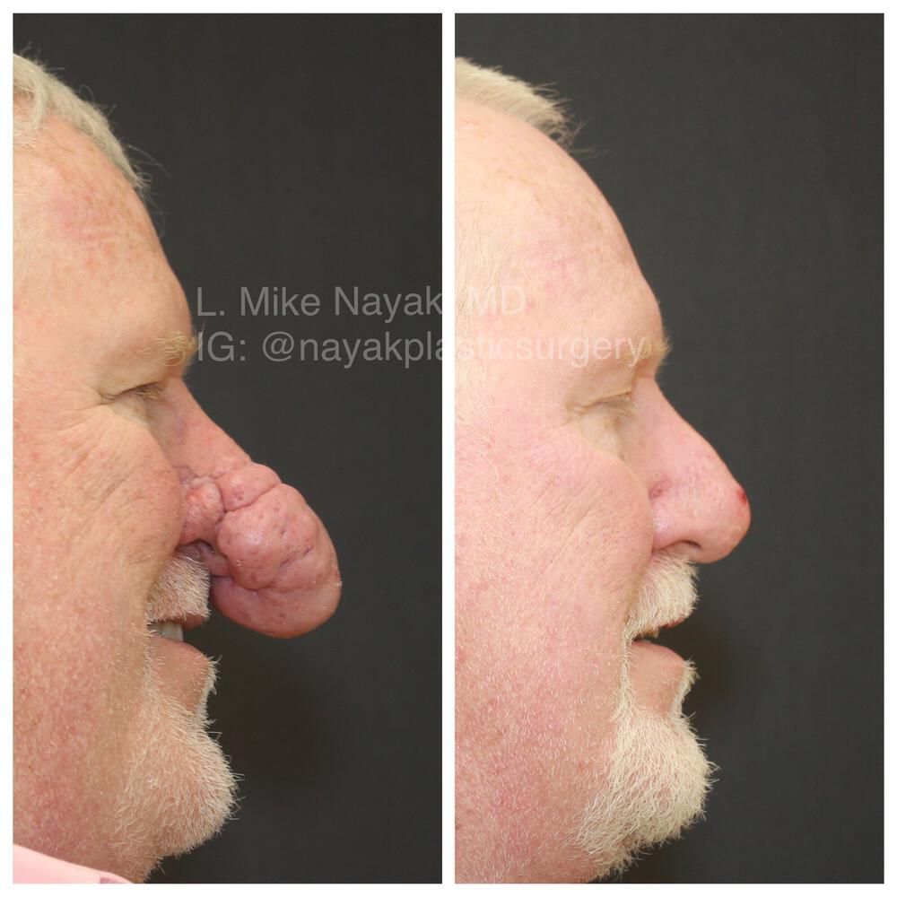 Rhinophyma Reduction Before & After