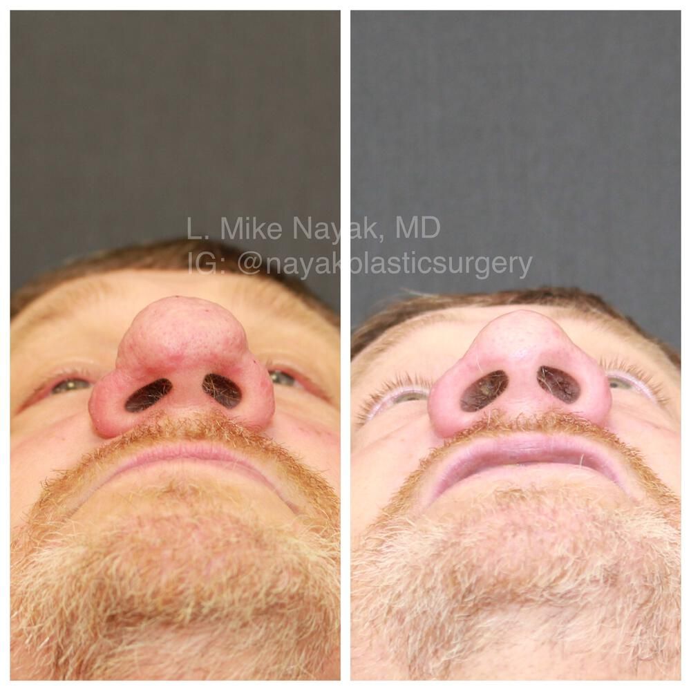 Rhinophyma Reduction Before & After