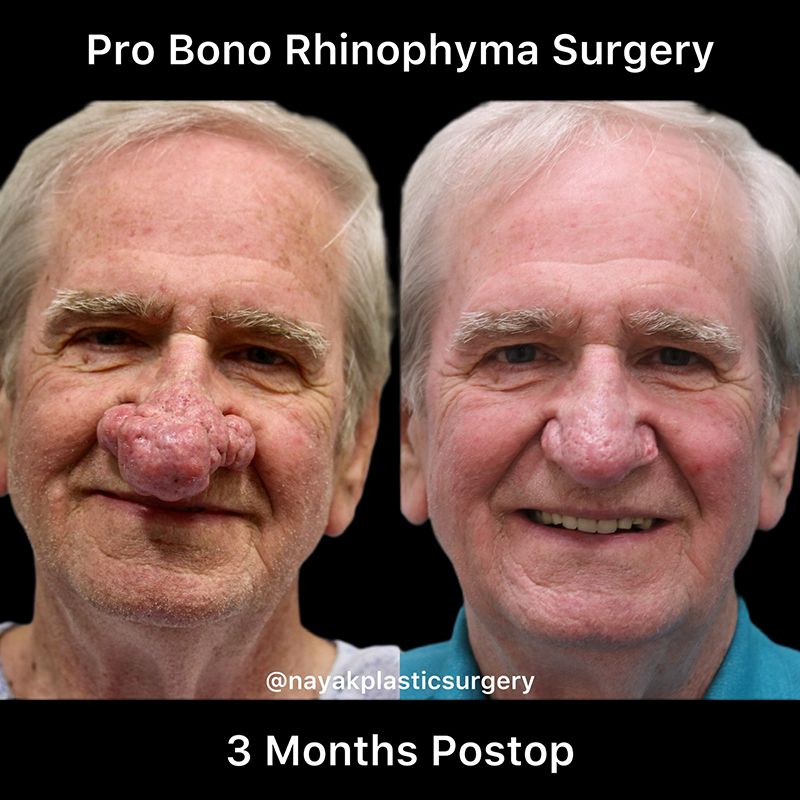 Rhinophyma Reduction Before & After