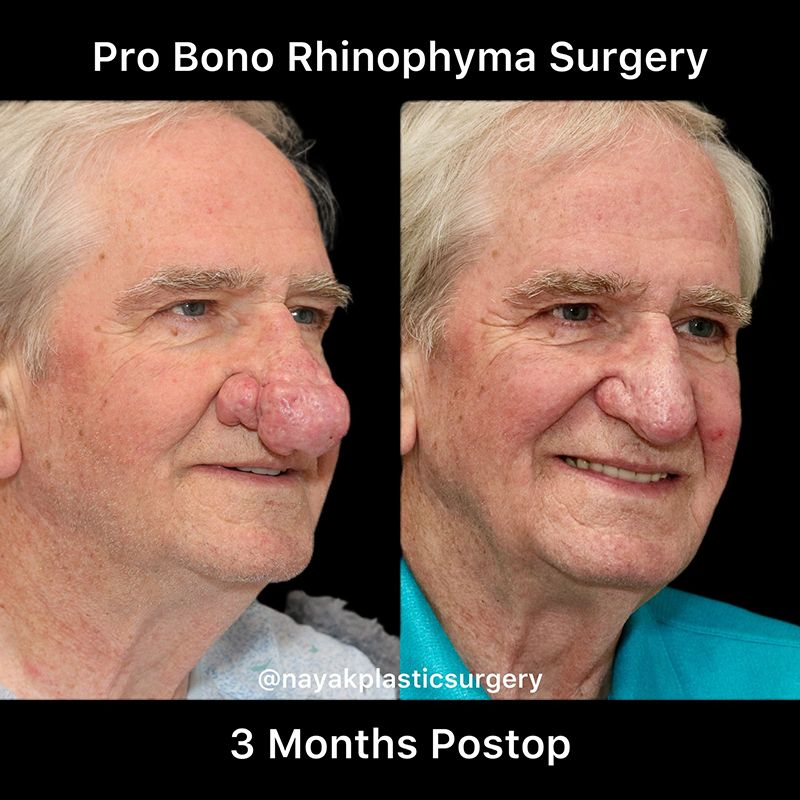 Rhinophyma Reduction Before & After