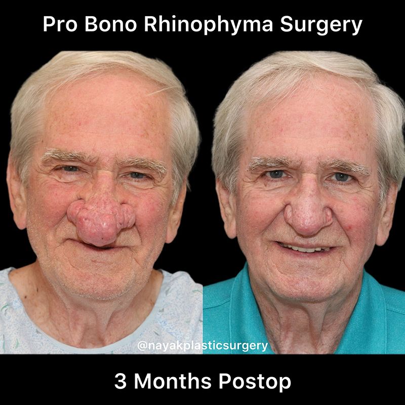 Rhinophyma Reduction Before & After