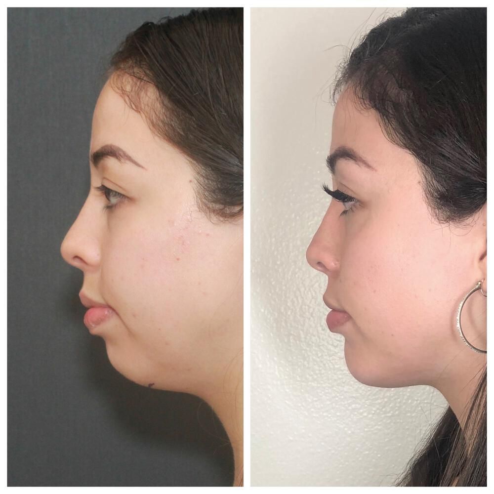 Buccal Fat Removal Before & After