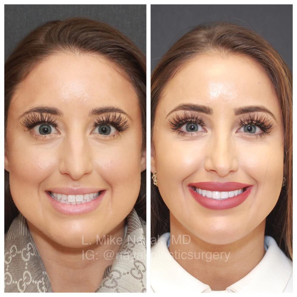 Buccal Fat Removal Before & After