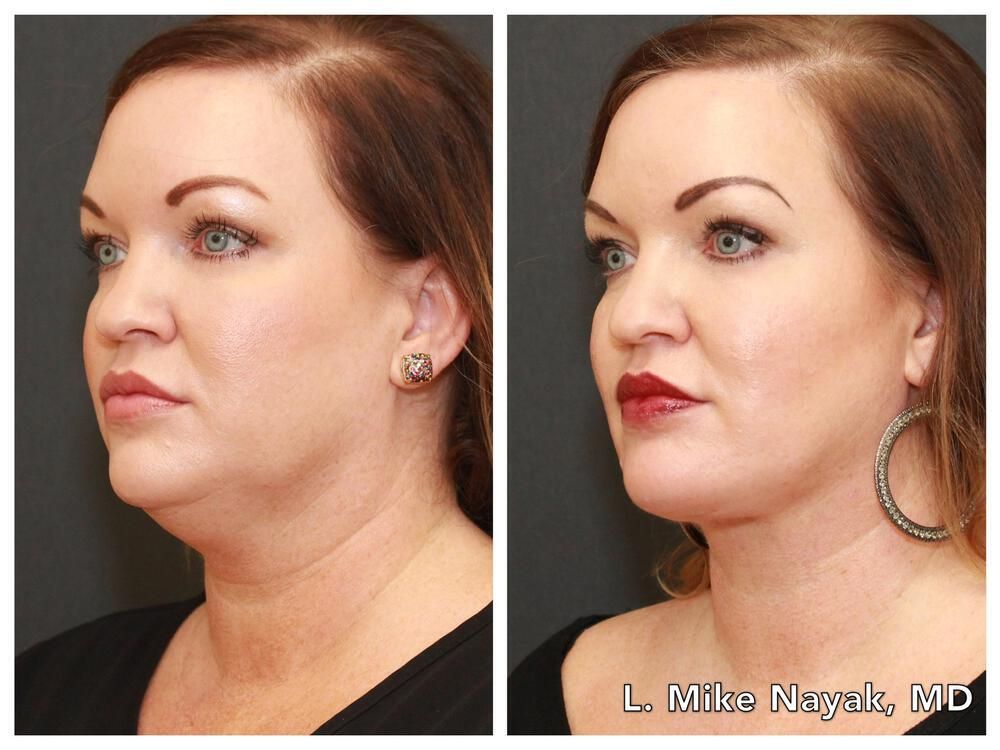 Buccal Fat Removal Before & After