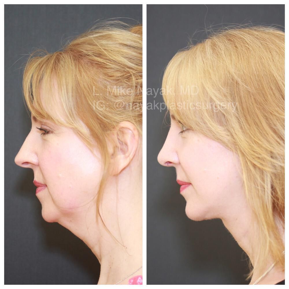 Buccal Fat Removal Before & After