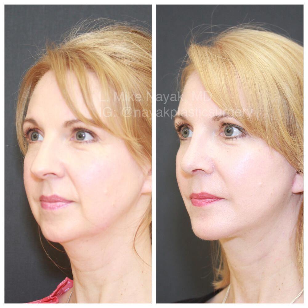 Buccal Fat Removal Before & After