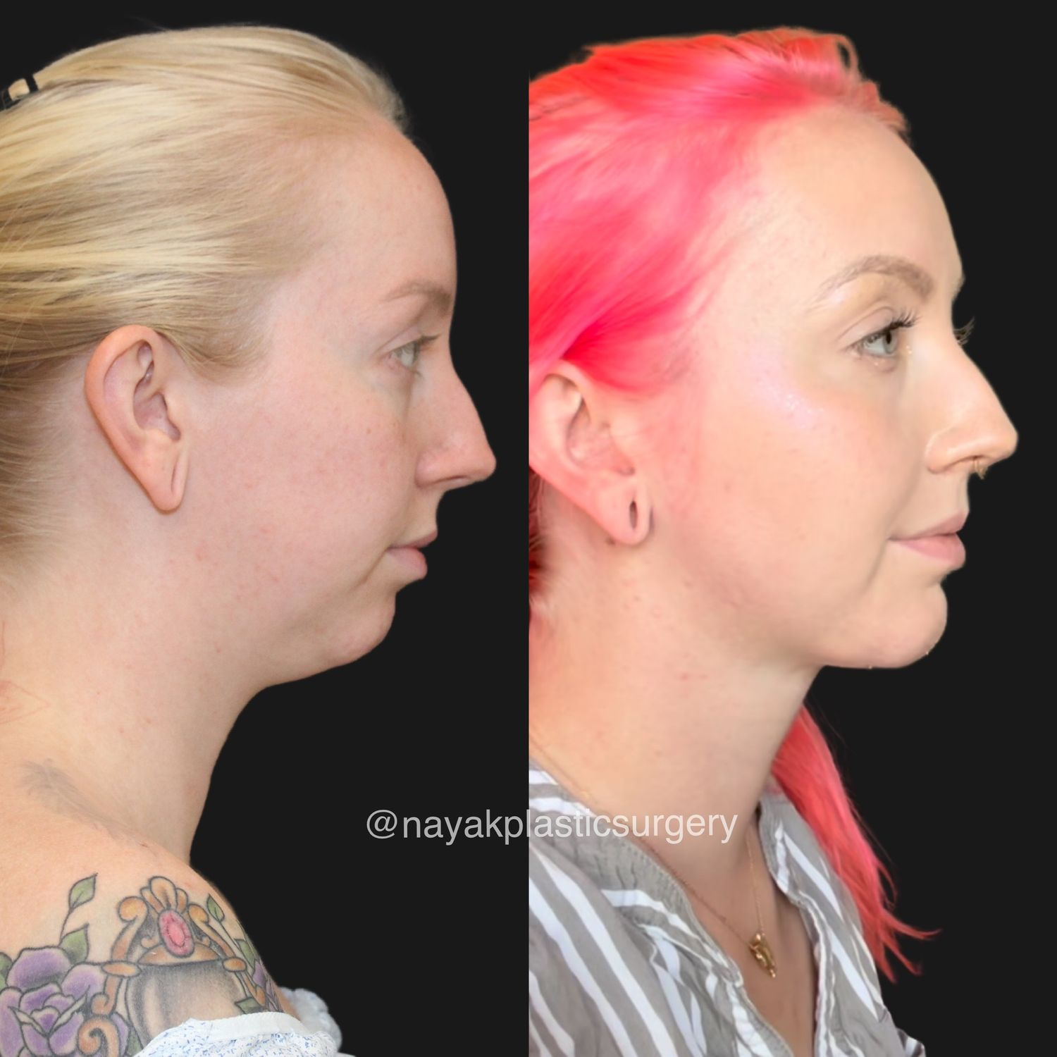 Buccal Fat Removal Before & After