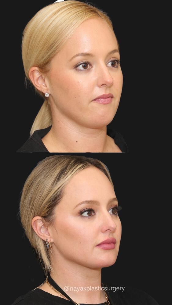 Buccal Fat Removal Before & After