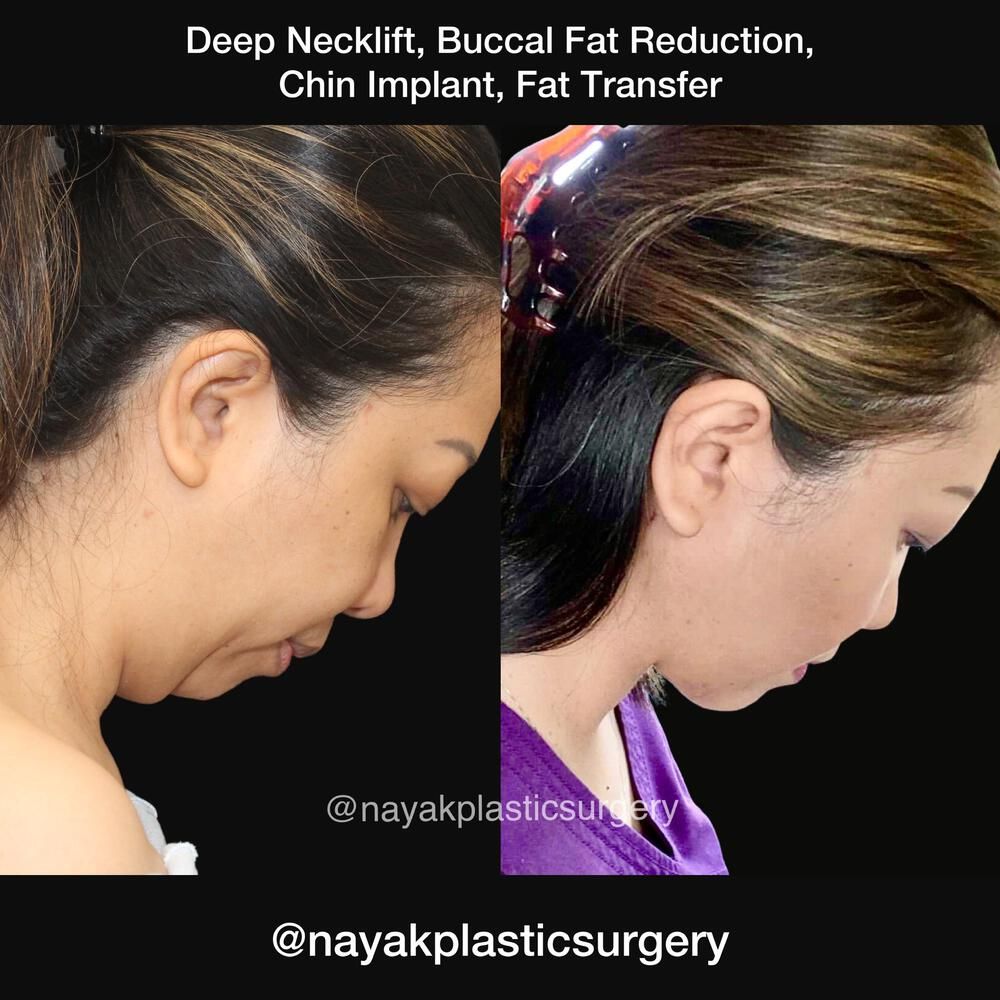 Buccal Fat Removal Before & After