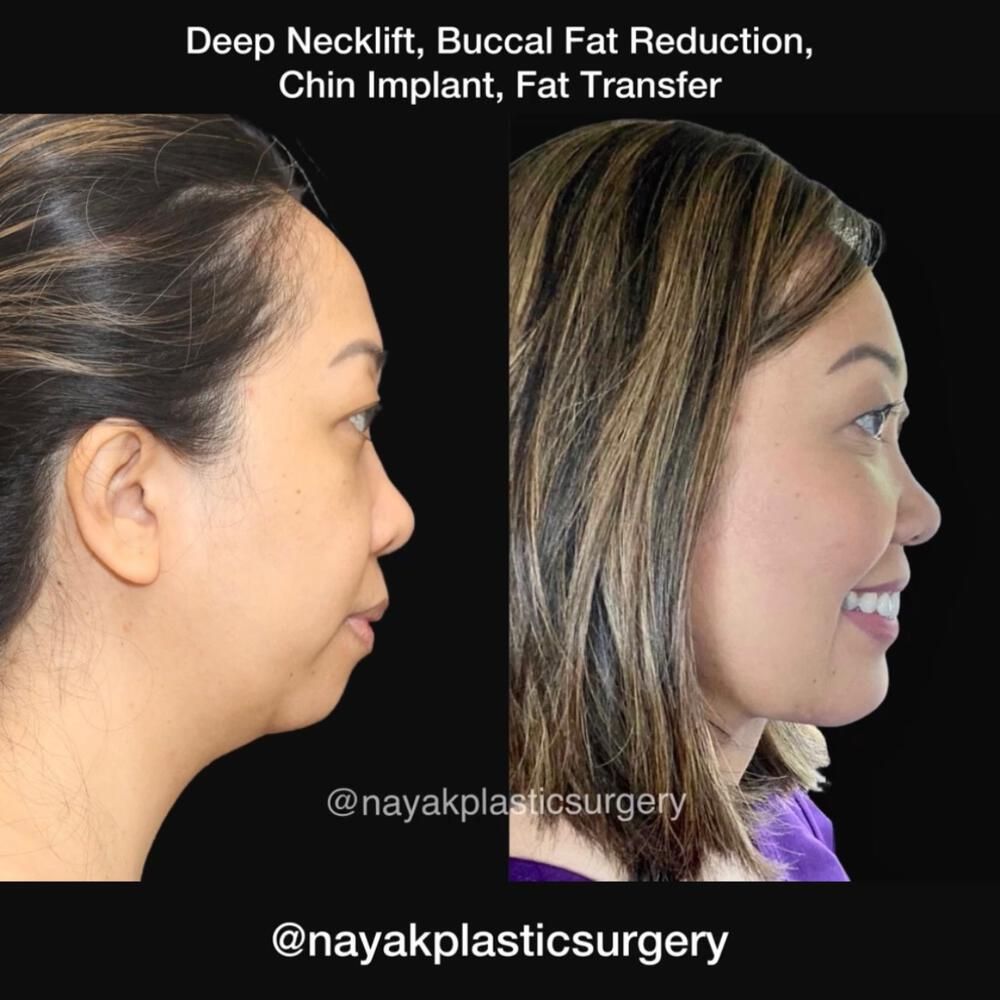 Buccal Fat Removal Before & After