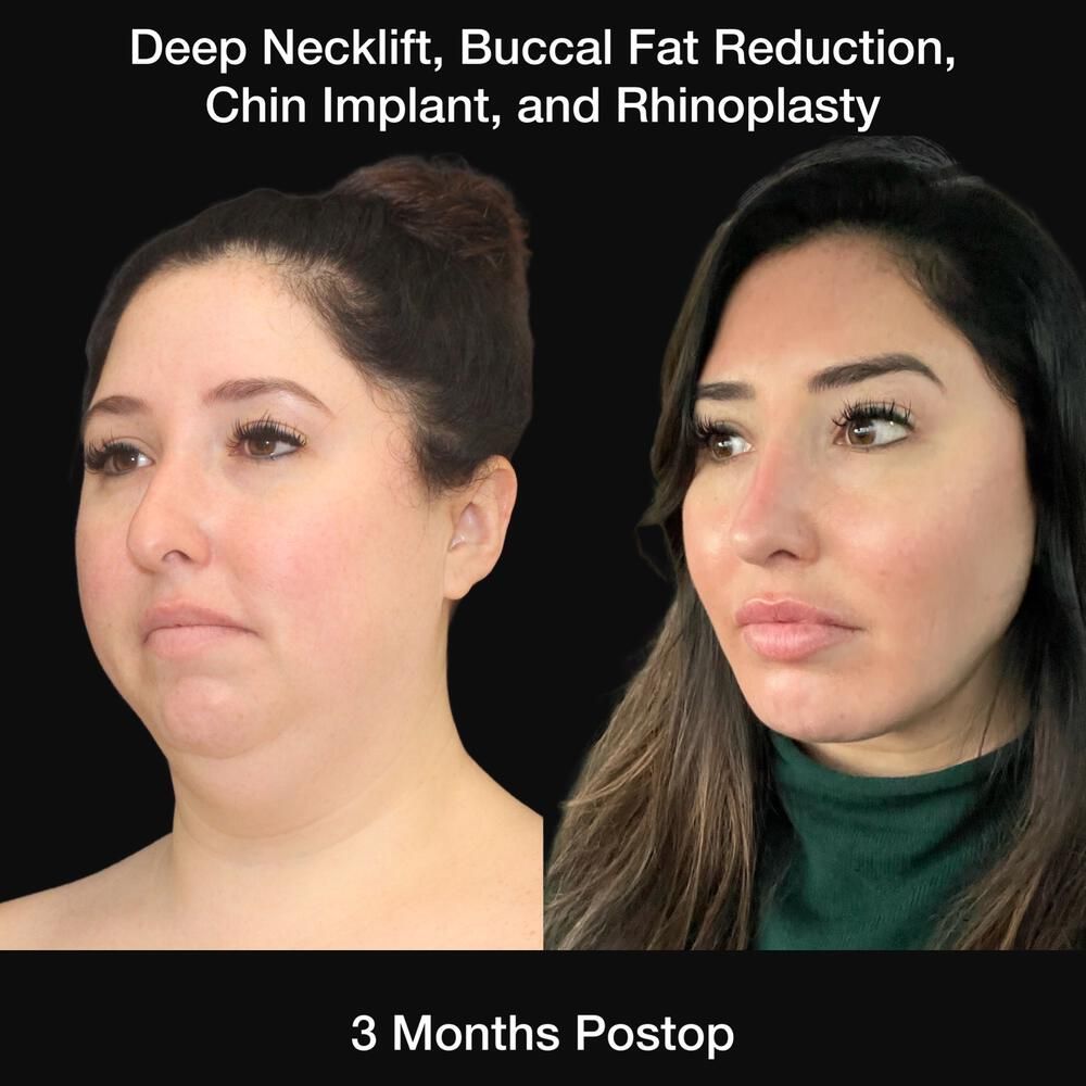 Buccal Fat Removal Before & After