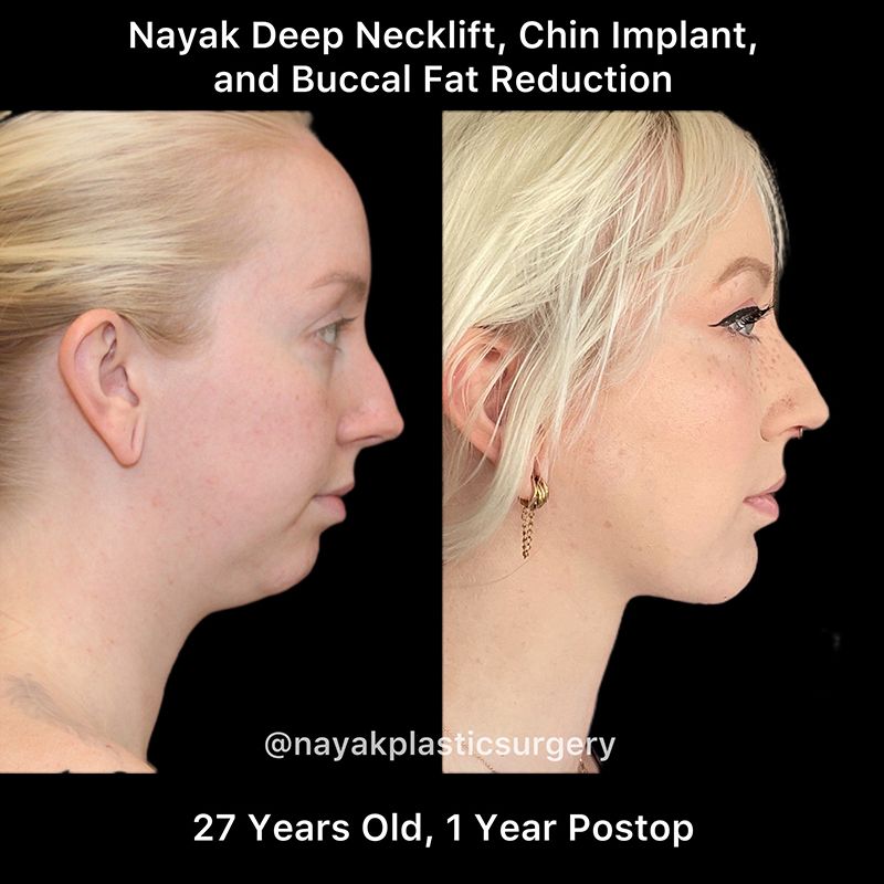 Buccal Fat Removal Before & After