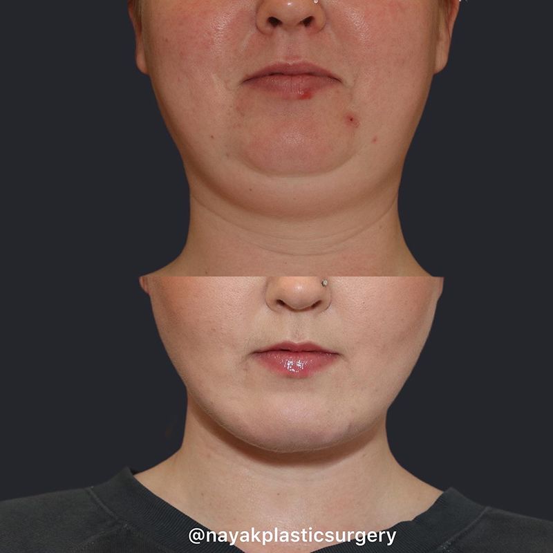 Buccal Fat Removal Before & After