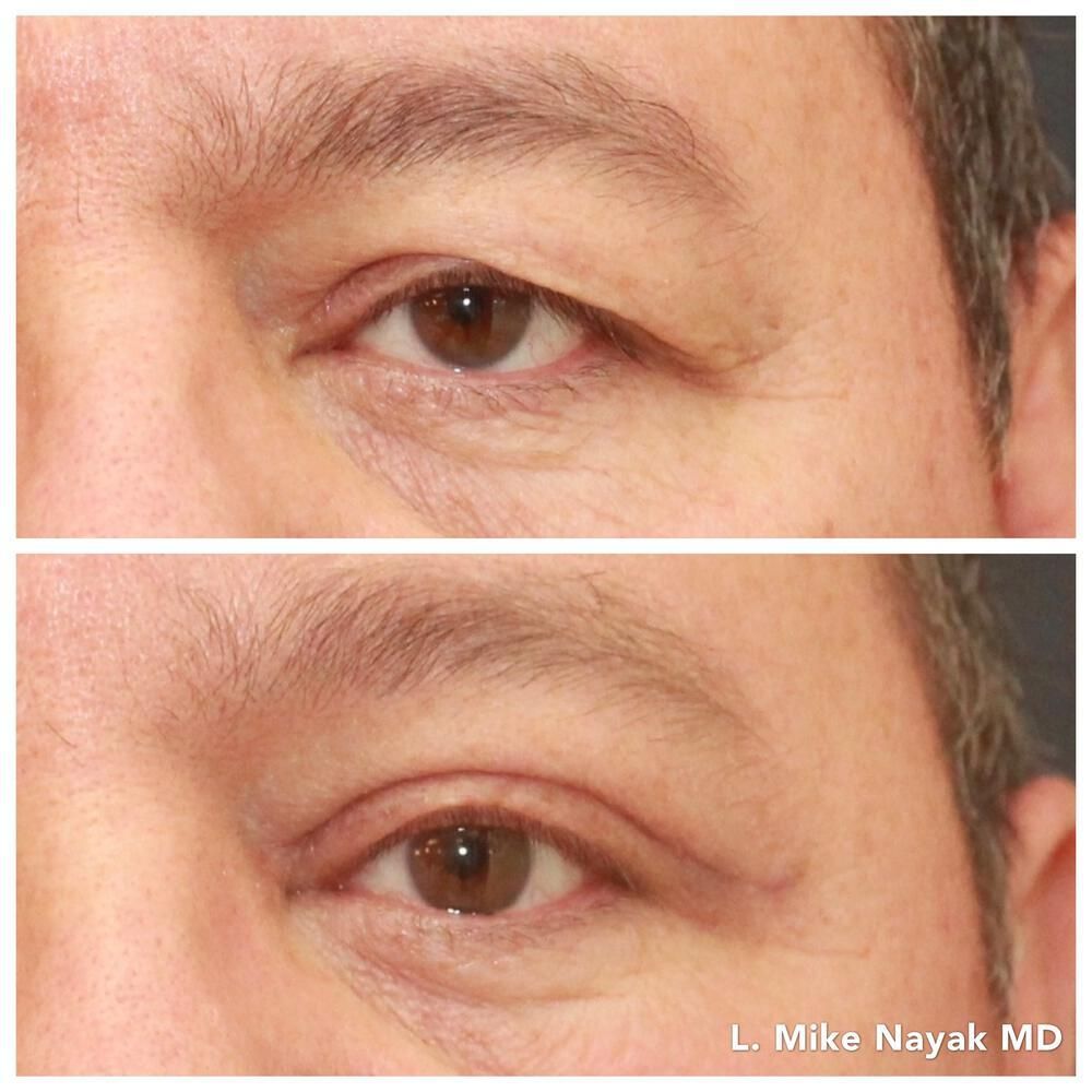 Eyelid Surgery Before & After