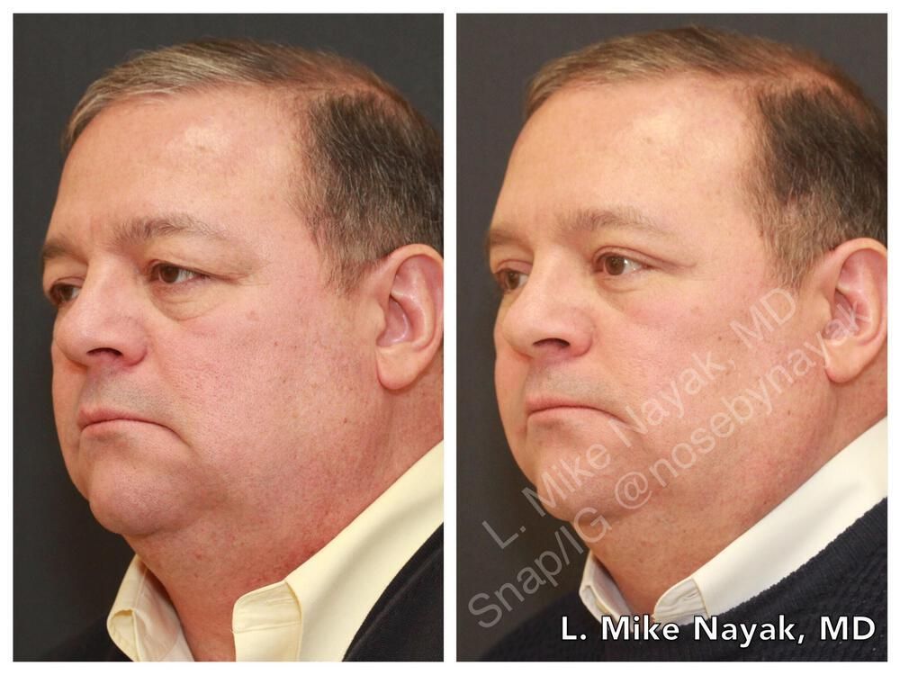 Eyelid Surgery Before & After