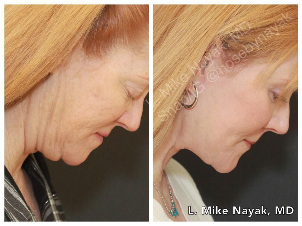 Eyelid Surgery Before & After