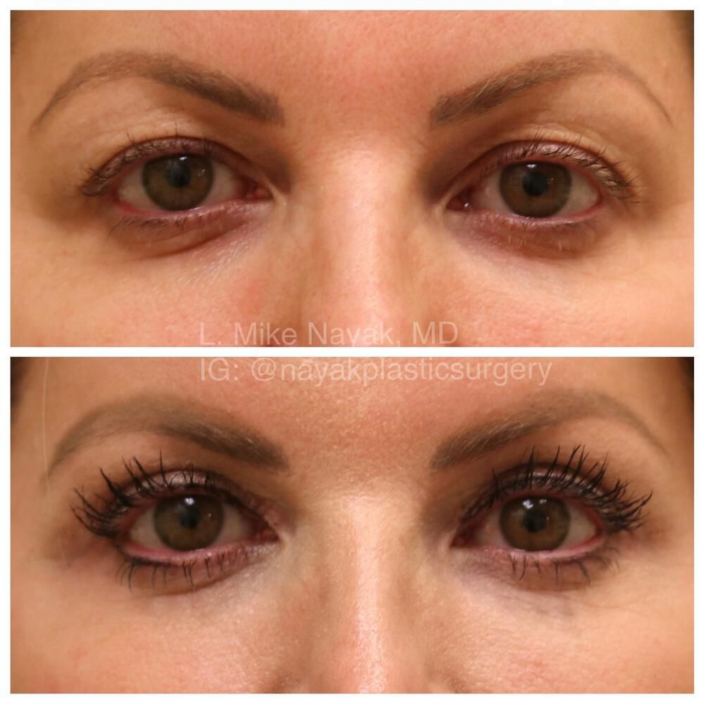 Eyelid Surgery Before & After