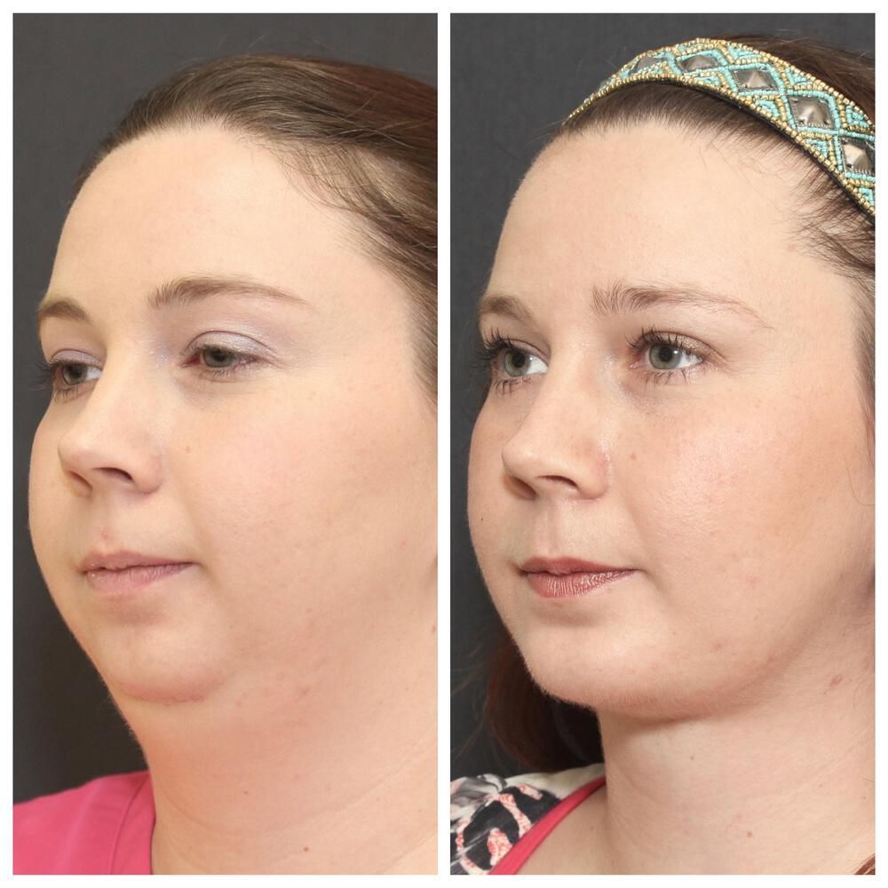 Chin Implant Before & After