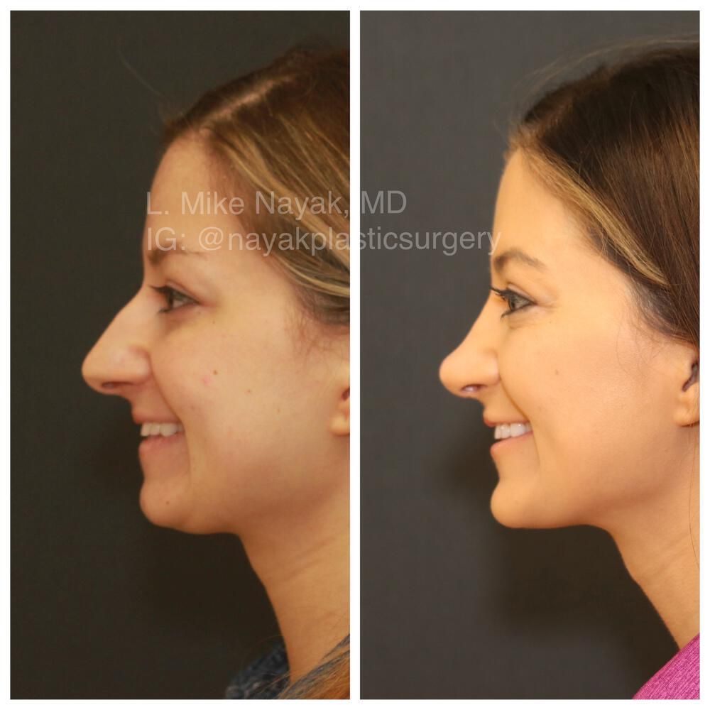 Chin Implant Before & After
