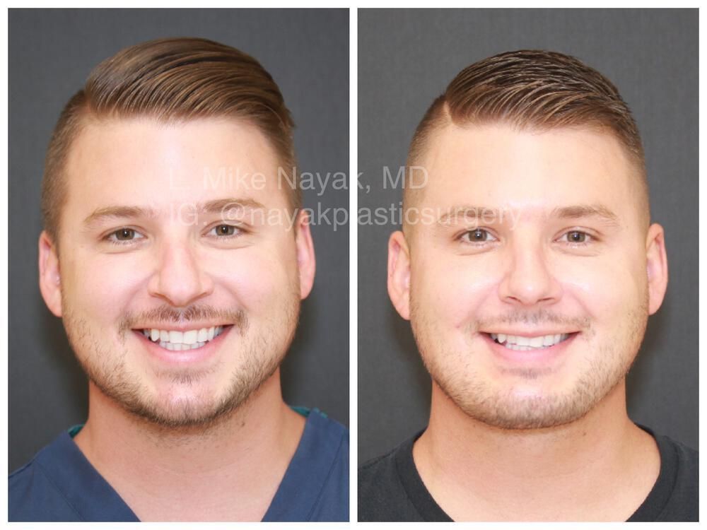 Chin Implant Before & After