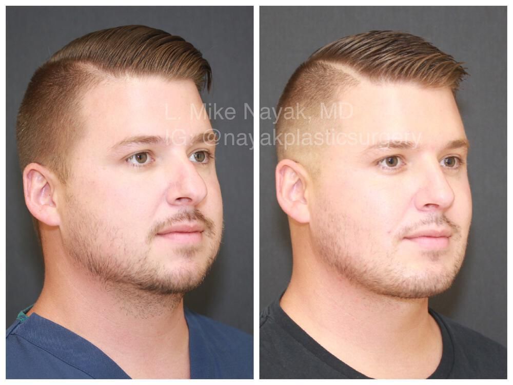 Chin Implant Before & After