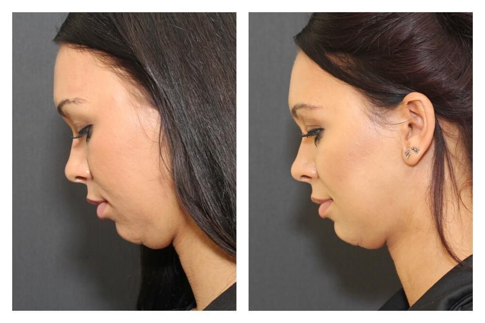 Chin Implant Before & After