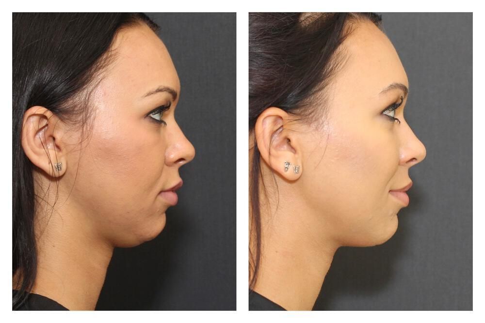Chin Implant Before & After