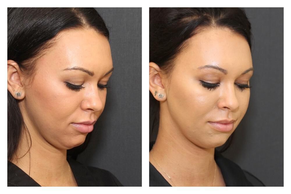 Chin Implant Before & After