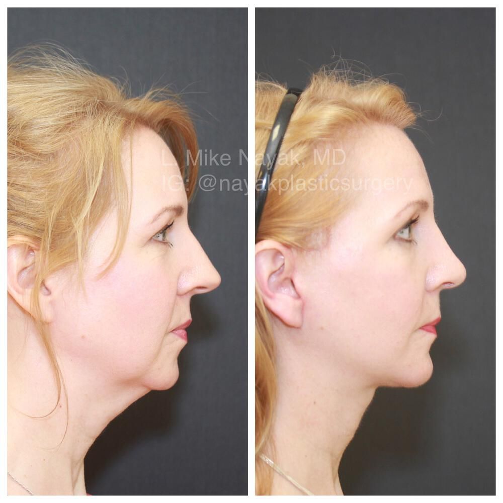 Chin Implant Before & After
